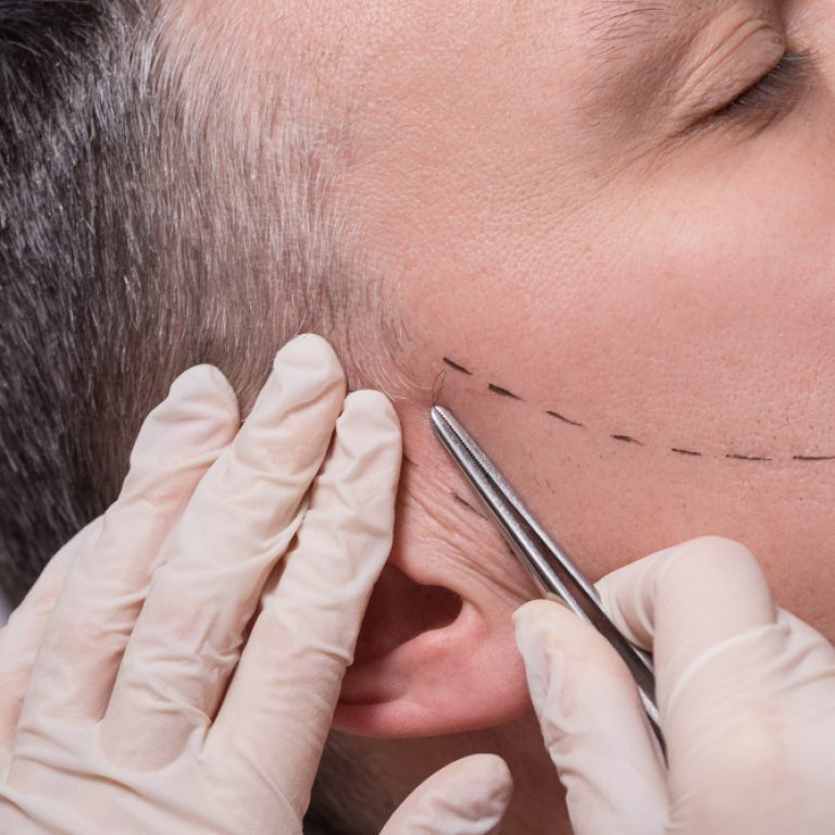 man-beauty-procedure-beard-hair-implant-senior-man